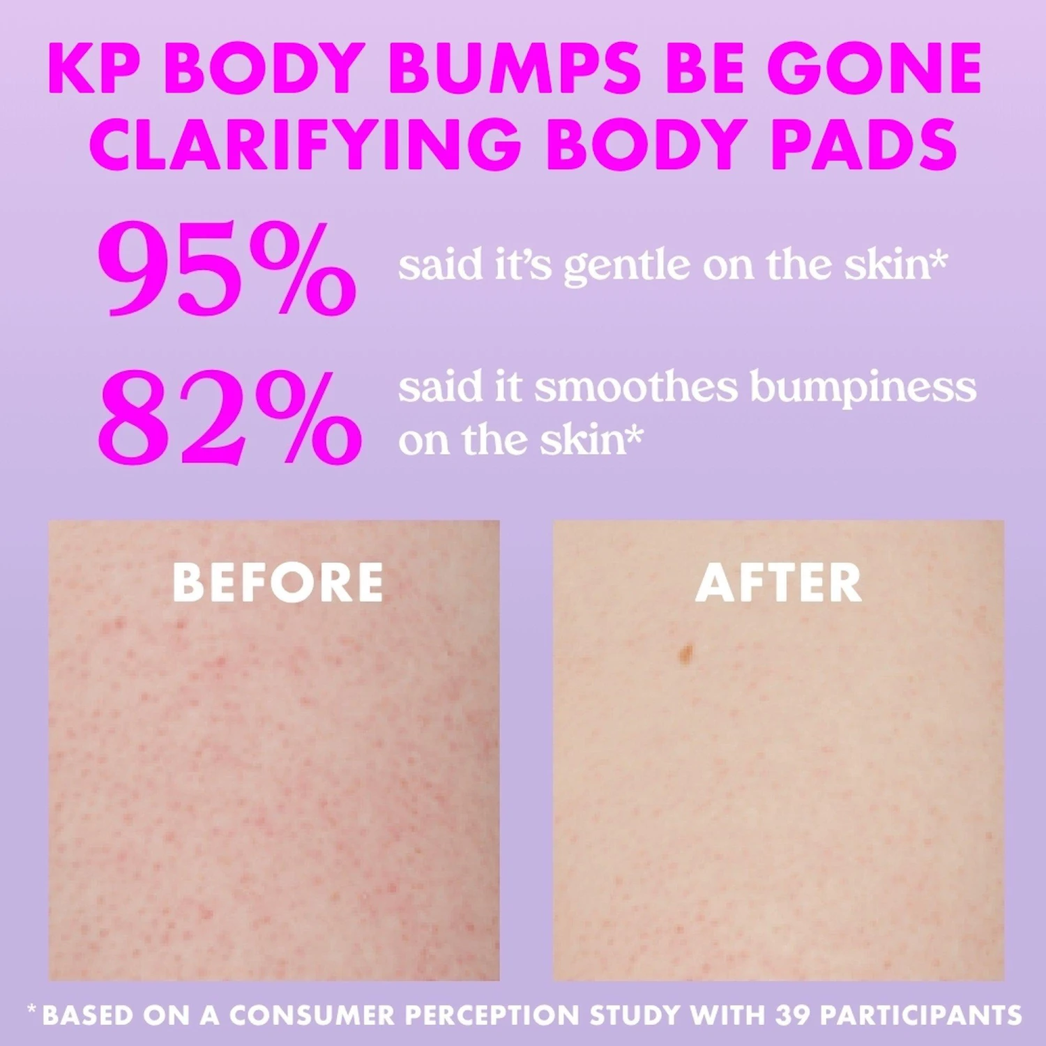 KP Body Bumps Be Gone Clarifying Body Pads 4 KP Body Bumps Be Gone Clarifying Body Pads - Image 4